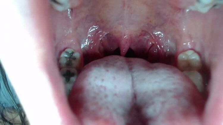 ManyVids - mia_isabella3 - Braces, mouth, uvula fetish